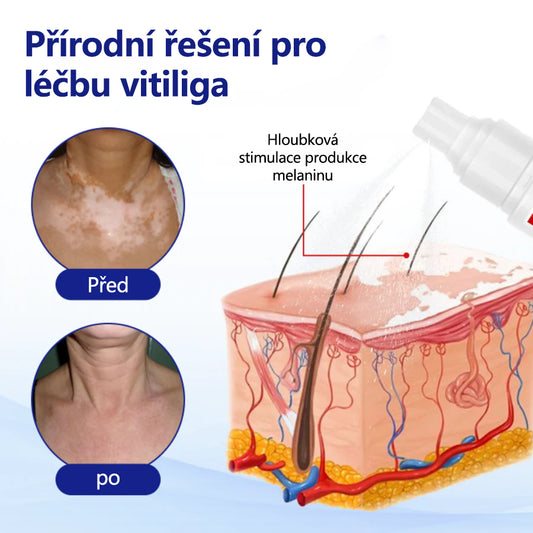 CleraNaure® sprej na vitiligo – cesta k vyvážené pleti