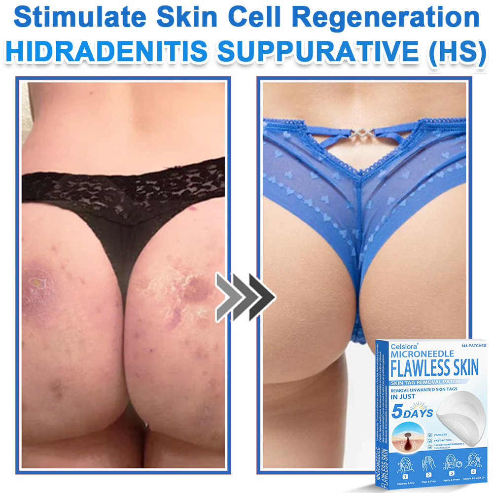 upsell-📌 Celsiora® 2-in-1 Microneedle & Hydrocolloid Patch | Raised Moles,Acne,  Flat Warts & Skin Tags Remover | Improves Wrinkles, Scars & Blemishes | Invisible Star Pimple Patches for Face & Body | 144 Count (Copy)