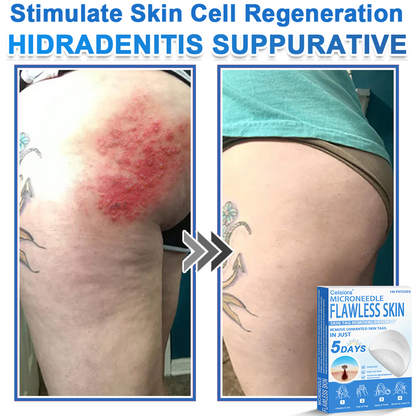 upsell-📌 Celsiora® 2-in-1 Microneedle & Hydrocolloid Patch | Raised Moles,Acne,  Flat Warts & Skin Tags Remover | Improves Wrinkles, Scars & Blemishes | Invisible Star Pimple Patches for Face & Body | 144 Count (Copy)