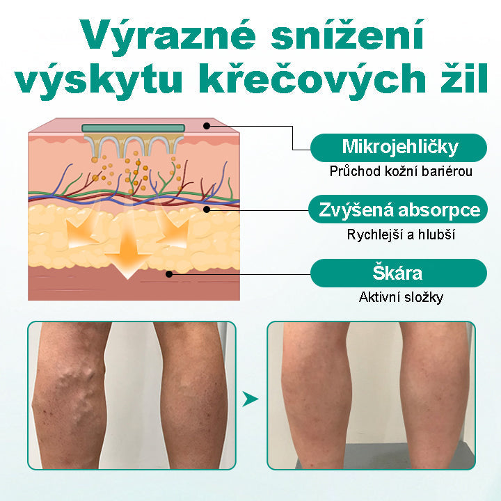CleraNaure® LegRenew Náplast na Křečové Žíly