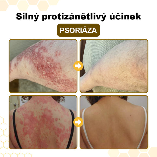 🛡️CleraNaure® PsoriaSoothe – regenerační krém s včelím jedem pro obnovu pleti