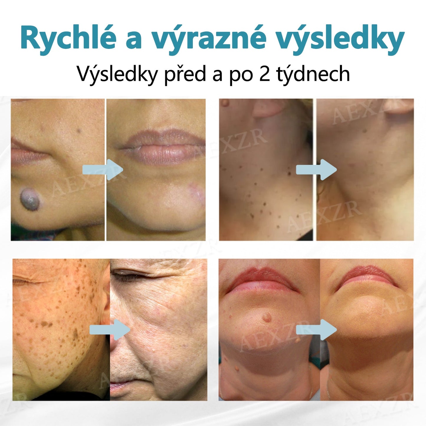 CleraNaure® PRO Neinvazivní laserové pero na odstraňování bradavic a znamének