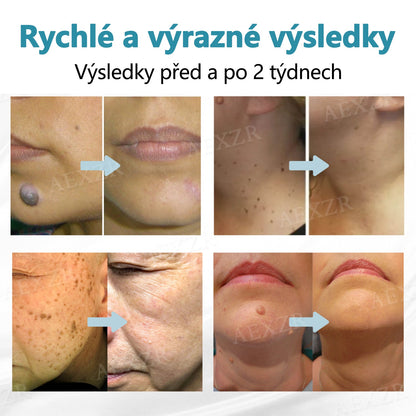 CleraNaure® PRO Neinvazivní laserové pero na odstraňování bradavic a znamének