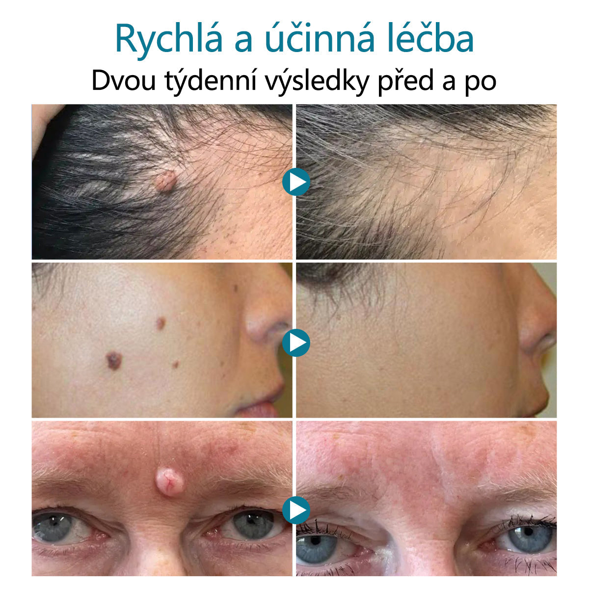 DAFEILA® LumeSkin – laserové pero pro odstraňování znamének a bradavic