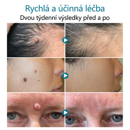 DAFEILA® LumeSkin – laserové pero pro odstraňování znamének a bradavic