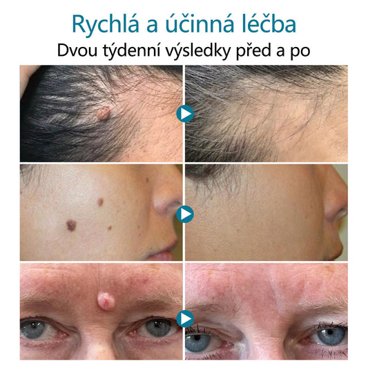 DAFEILA® LumeSkin – laserové pero pro odstraňování znamének a bradavic