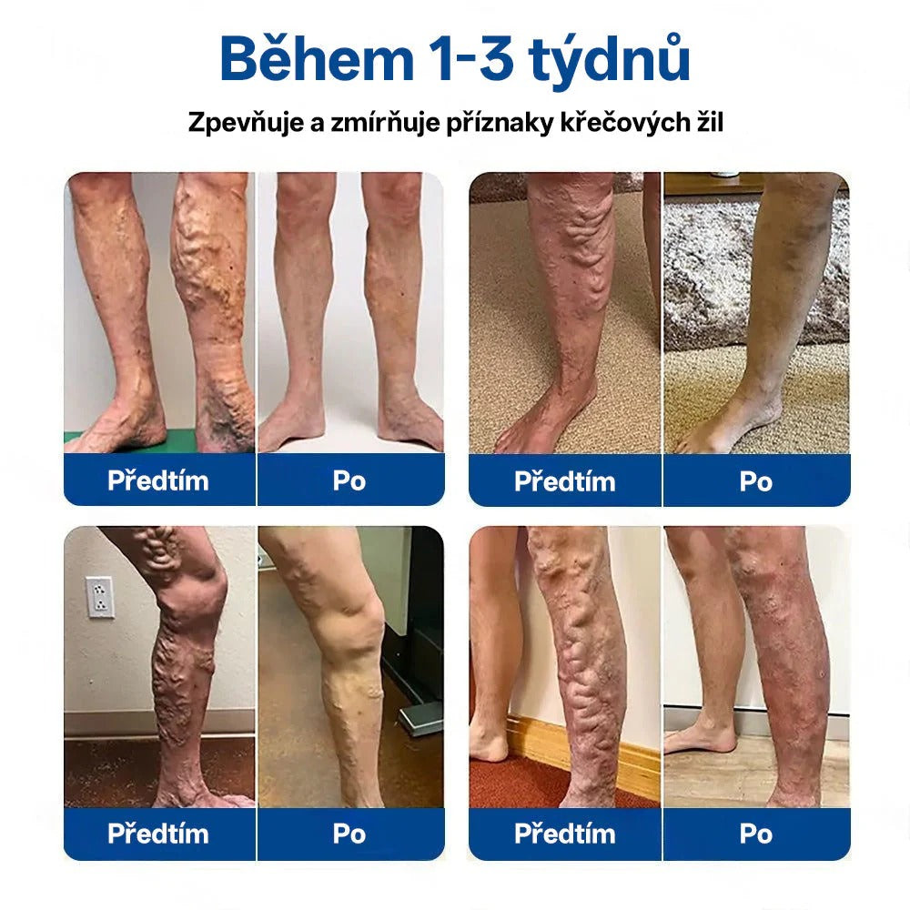 🥇Healrize® VeinTarget Mikronedlové Náplasti✨