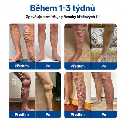 🥇Healrize® VeinTarget Mikronedlové Náplasti✨
