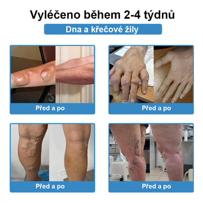 CleraNaure® Nano-microneedle kloubní náplast