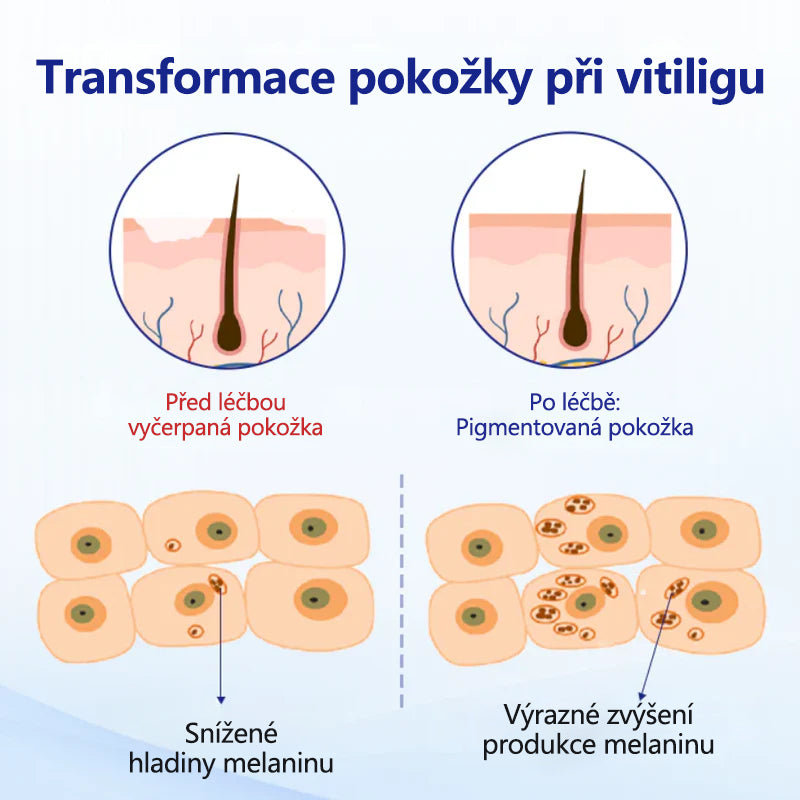 CleraNaure® sprej na vitiligo – cesta k vyvážené pleti
