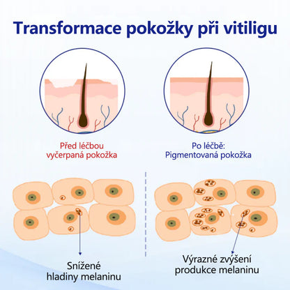 CleraNaure® sprej na vitiligo – cesta k vyvážené pleti