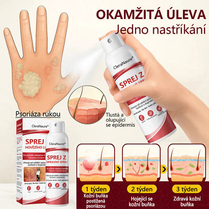 🔴CleraNature® Sprej s Hovězím Tvarohem pro Svědící, Olupující se Pokožku Při Psoriáze