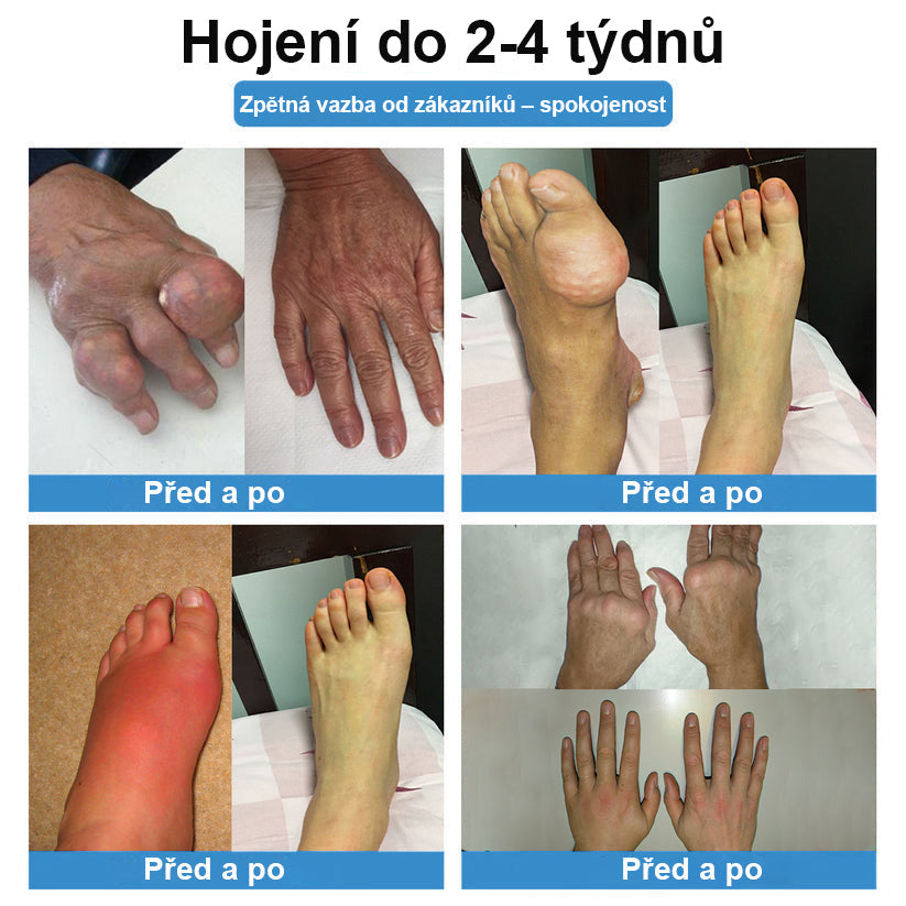 CleraNaure® Nano-microneedle kloubní náplast