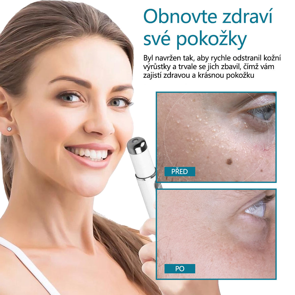 DAFEILA® LumeSkin – laserové pero pro odstraňování znamének a bradavic